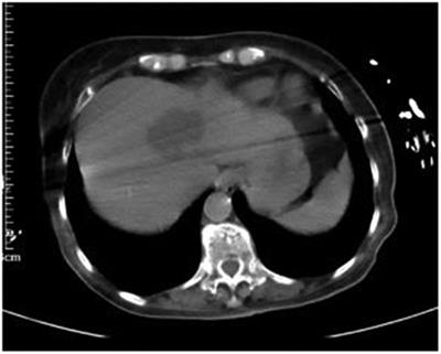 Klebsiella pneumoniae liver abscess with purulent meningitis and endogenous endophthalmitis: A case report
